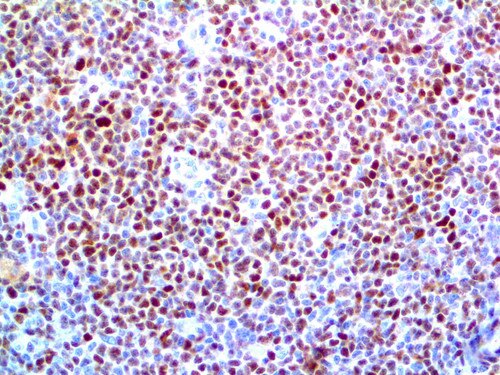 IHC of Cyclin D1 on an FFPE Mantle Cell Lymphoma Tissue